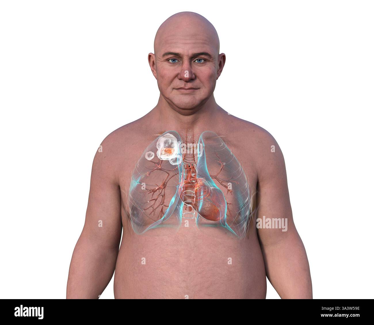 Illustration d'un homme avec des poumons atteints de tuberculose cavitaire dans le lobe supérieur droit, montrant des lésions pulmonaires et des cavités. Banque D'Images