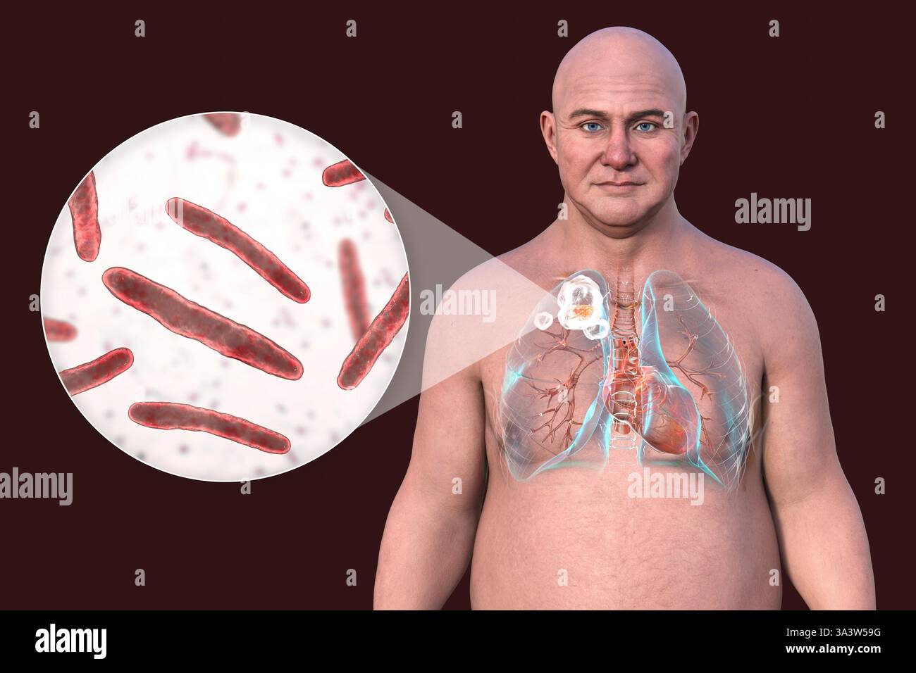 Illustration d'un homme avec des poumons atteints de tuberculose cavitaire dans le lobe supérieur droit, montrant des lésions pulmonaires et des cavités, ainsi qu'une vue rapprochée de la bactérie Mycobacterium tuberculosis. Banque D'Images