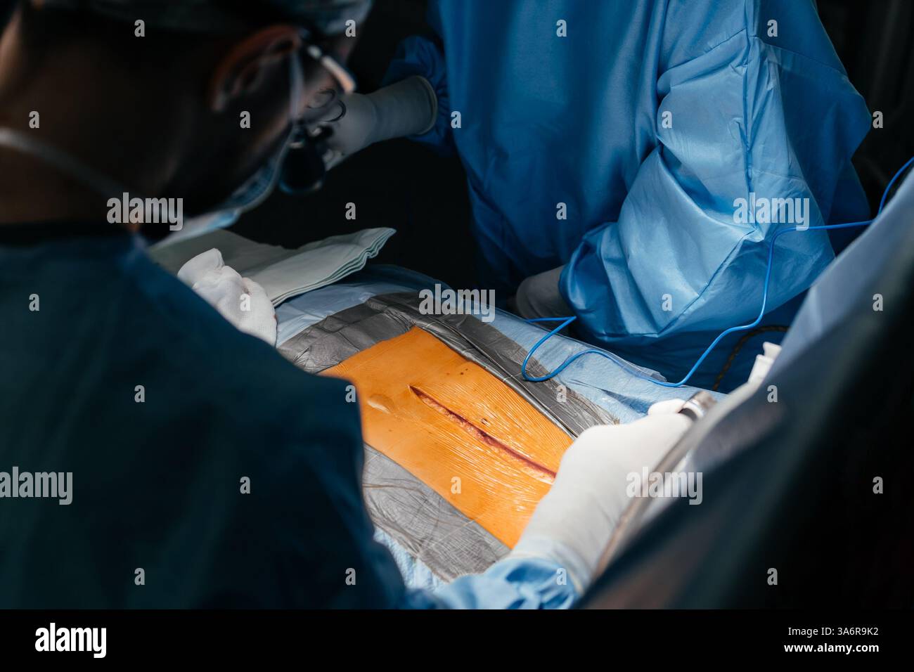 Gros plan équipe diversifiée de chirurgiens pratiquant la chirurgie sur un patient dans la salle d'opération de l'hôpital. Traitement urgent, chirurgie plastique. Banque D'Images