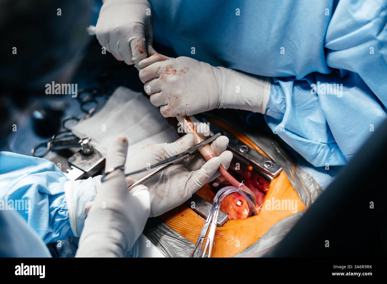 Gros plan équipe chirurgicale concentrée opérant un patient à l'hôpital. Santé et concept médical. Les médecins effectuent une opération cardiaque Banque D'Images