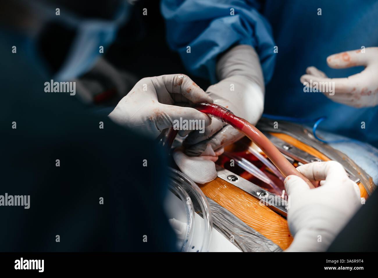 Gros plan équipe chirurgicale concentrée opérant un patient à l'hôpital. Santé et concept médical. Les médecins effectuent une opération cardiaque Banque D'Images