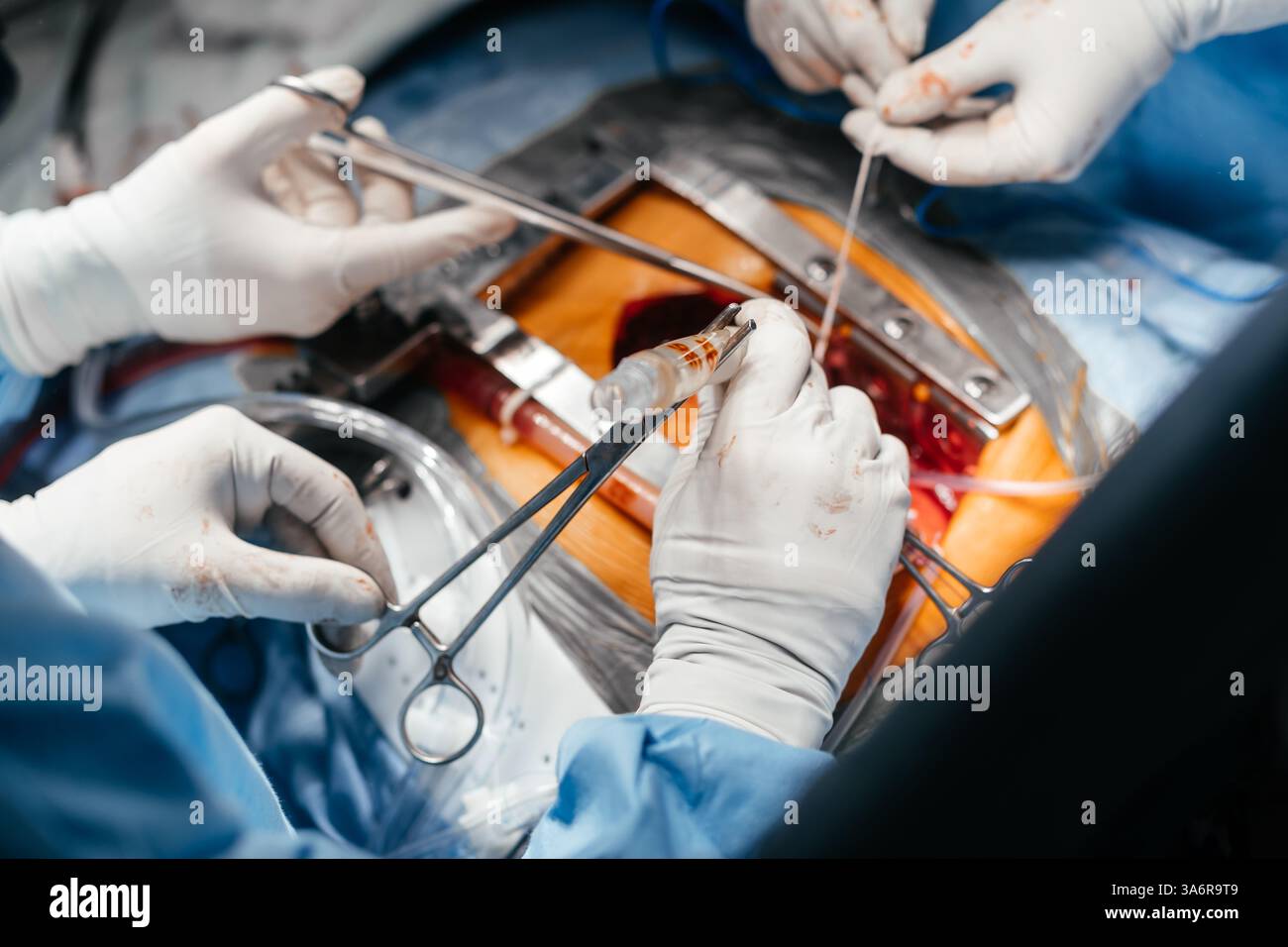 Gros plan équipe chirurgicale concentrée opérant un patient à l'hôpital. Santé et concept médical. Les médecins effectuent une opération cardiaque Banque D'Images