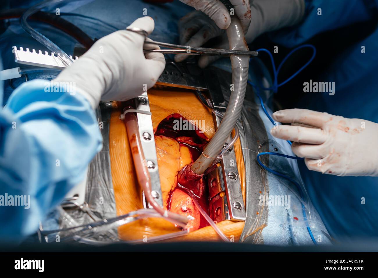 Les médecins effectuent une greffe de stent cardiaque chirurgicale dans un hôpital. Les chirurgiens travaillent pour sauver le patient à l'hôpital. Médecine, santé Banque D'Images