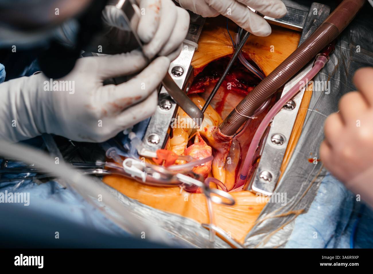 Les médecins effectuent une greffe de stent cardiaque chirurgicale dans un hôpital. Les chirurgiens travaillent pour sauver le patient à l'hôpital. Médecine, santé Banque D'Images
