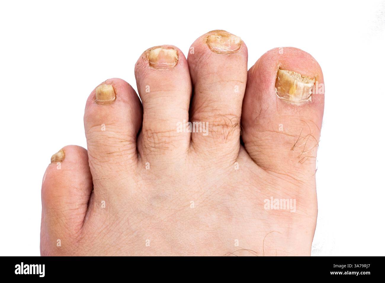 Orteils endommagés par un champignon de l'ongle. Banque D'Images