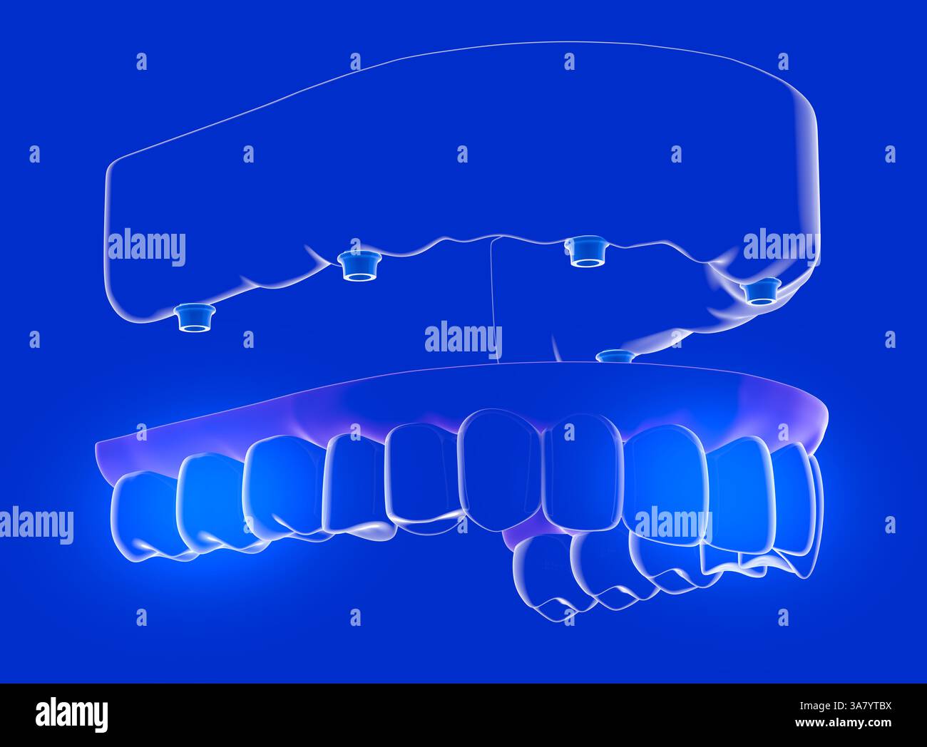 Illustration 3D d'une prothèse en verre transparent. Avant de le placer sur une gencive transparente et sans dents. Avec implants dentaires pour soutenir la prothèse. Banque D'Images