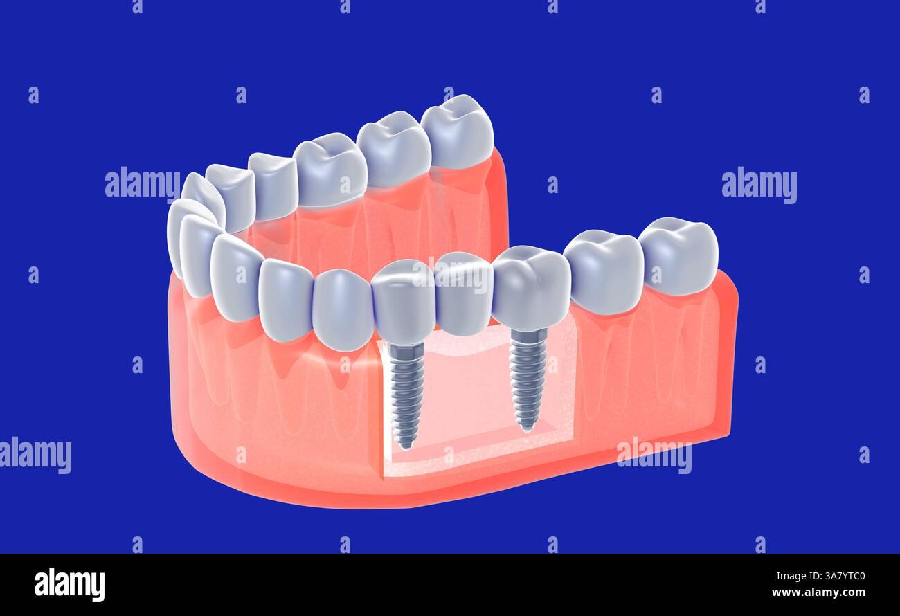 Illustration 3D d'un implant double placé dans une gencive dans un style graphique réaliste. Implant à trois dents. Montrant l'intérieur . Banque D'Images
