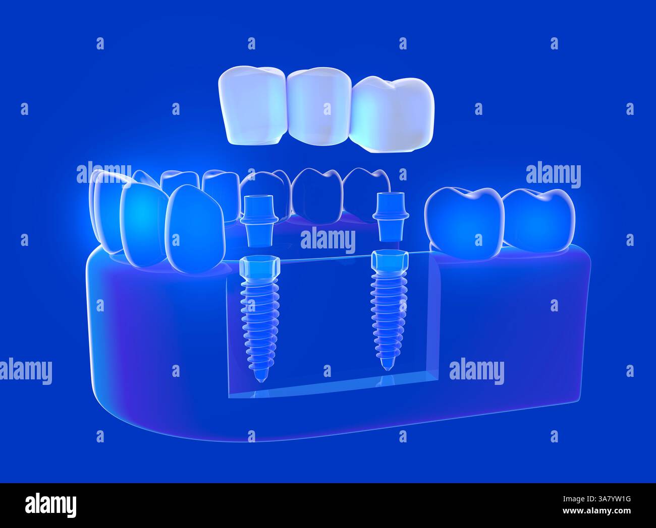 Illustration 3D d'un implant double placé dans une gomme de verre transparente. Implant à trois dents. Montrant l'intérieur transparent avec la lumière. Banque D'Images