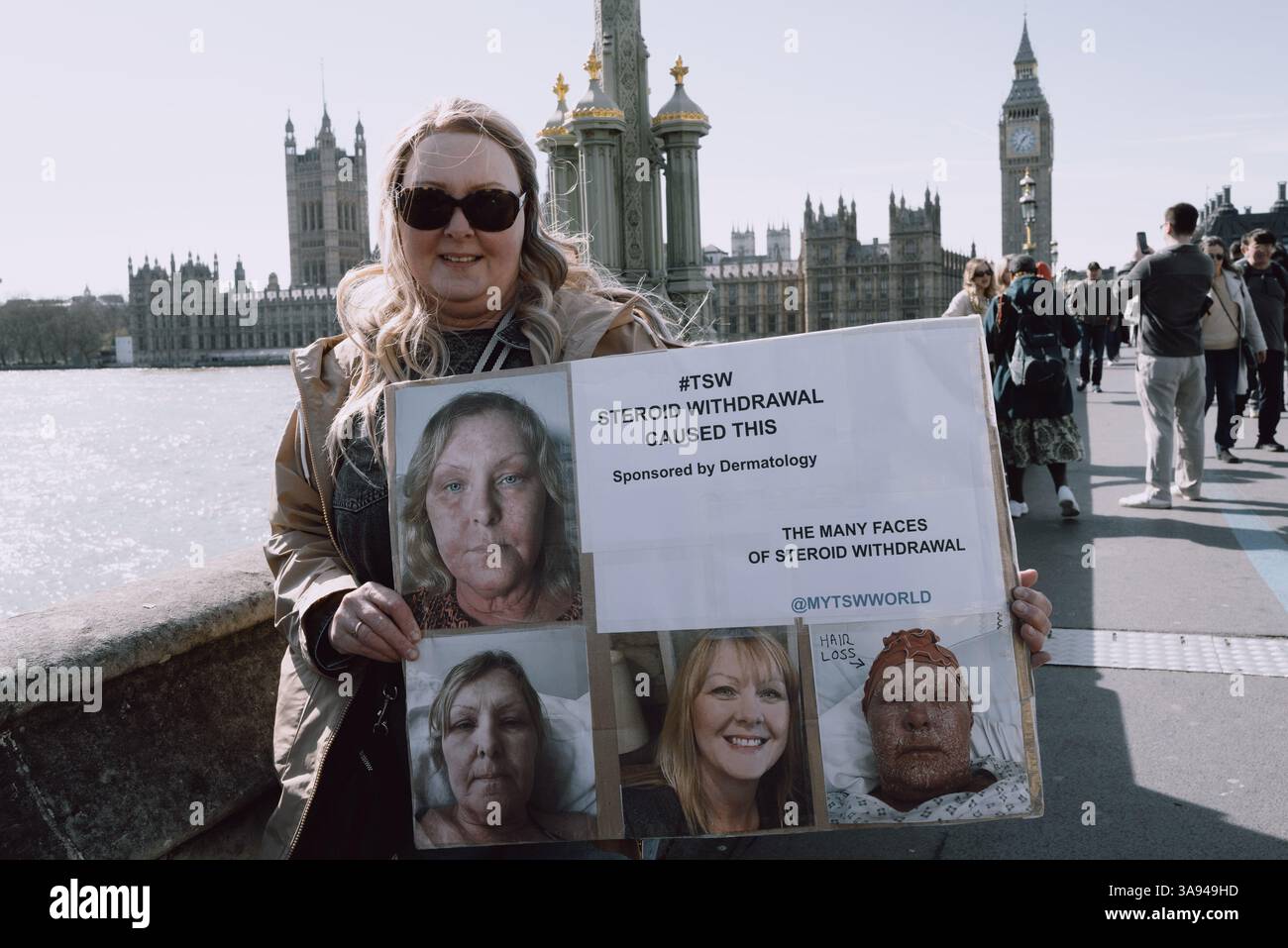 Londres, Royaume-Uni. 29 mars 2025. Un groupe de personnes touchées par le sevrage topique des stéroïdes (TSW) organise une manifestation à Parliament Square, Londres, exhortant le NHS à revoir ses protocoles de prescription des stéroïdes topiques. Les manifestants allèguent que le mauvais usage de ces traitements pour des affections comme l'eczéma a entraîné d'importantes souffrances chez les patients. Ils réclament une sensibilisation accrue et des lignes directrices plus strictes pour prévenir les effets indésirables associés à l'utilisation prolongée de stéroïdes. (Photo de Joao Daniel Pereira/Sipa USA) crédit : Sipa USA/Alamy Live News Banque D'Images