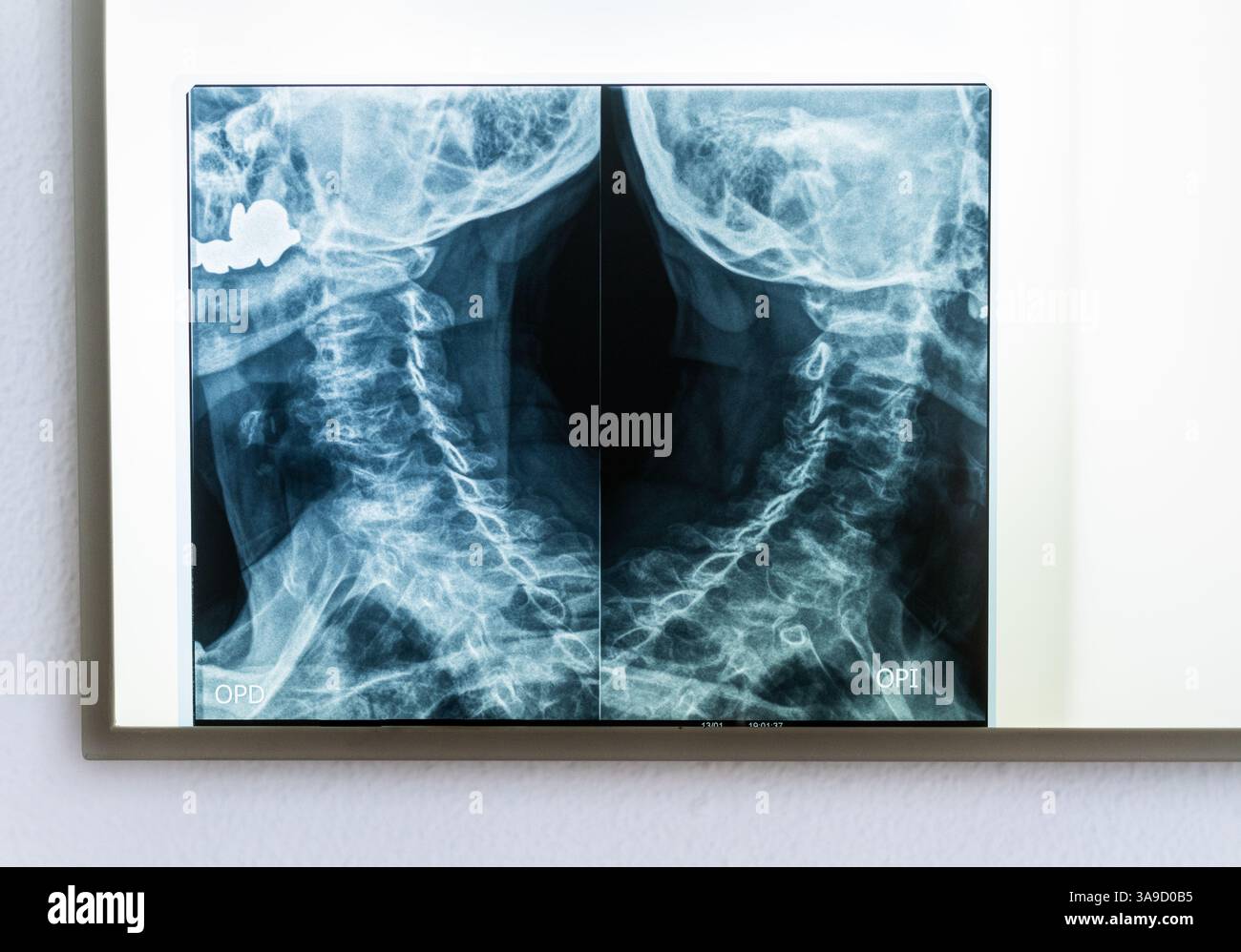 Vue en détail d'une boîte de visualisation de radiographies de la consultation d'un médecin avec la radiographie du col de l'utérus et de la base de la grue d'un Pat Banque D'Images