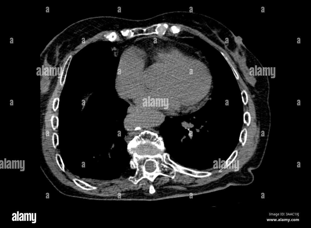 Tomodensitométrie d'une grand-mère après une chute avec ostéoporose et fractures par compression des vertèbres Th9-Th12, ainsi qu'une chirurgie sur la L1- Banque D'Images