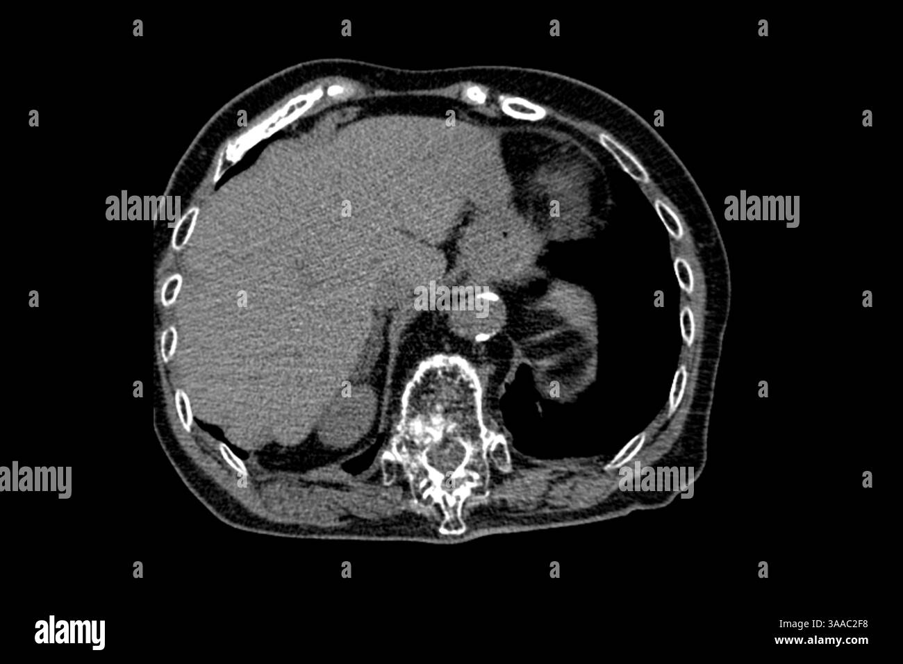 Tomodensitométrie d'une grand-mère après une chute avec ostéoporose et fractures par compression des vertèbres Th9-Th12, ainsi qu'une chirurgie sur la L1- Banque D'Images