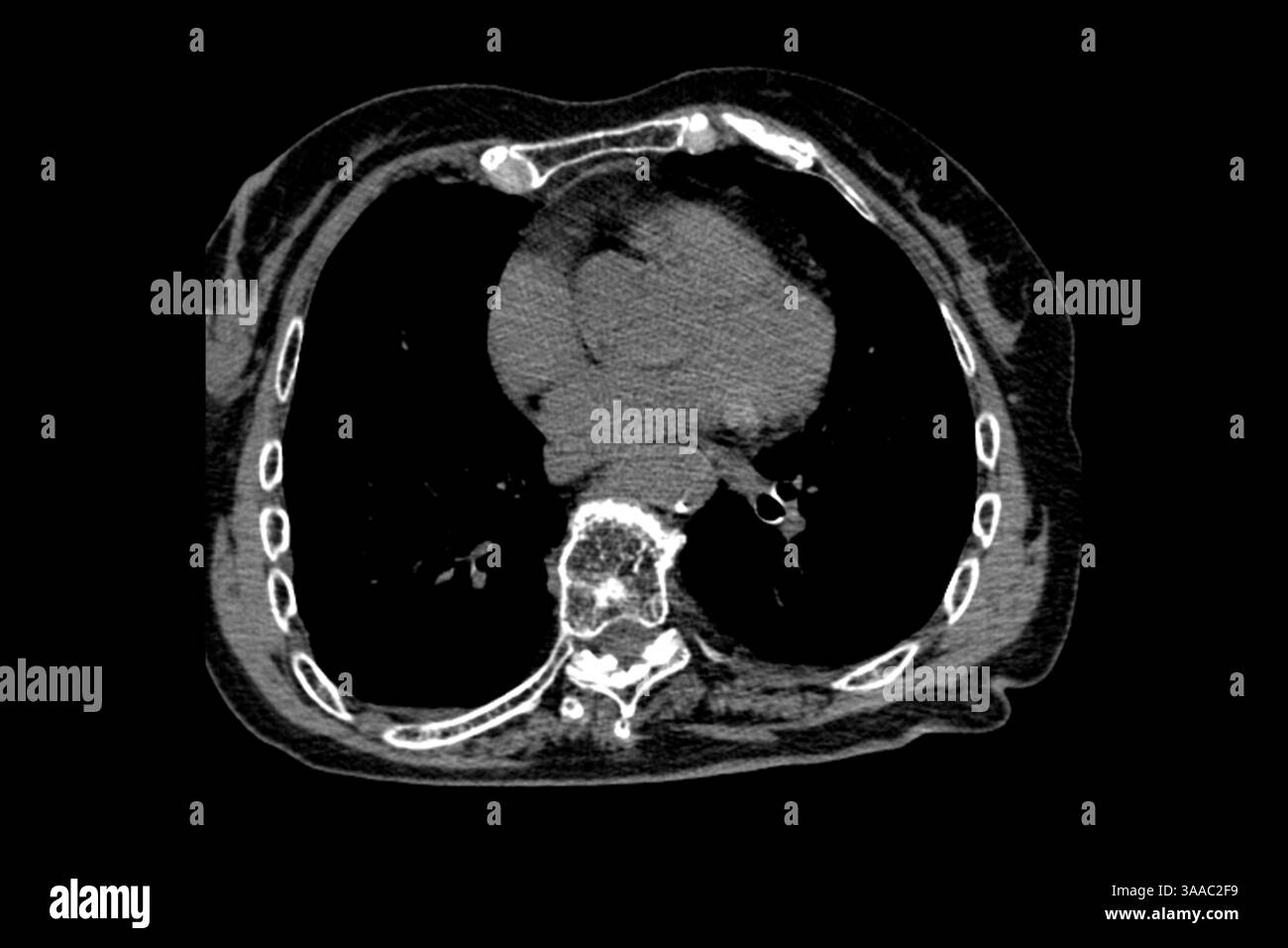 Tomodensitométrie d'une grand-mère après une chute avec ostéoporose et fractures par compression des vertèbres Th9-Th12, ainsi qu'une chirurgie sur la L1- Banque D'Images