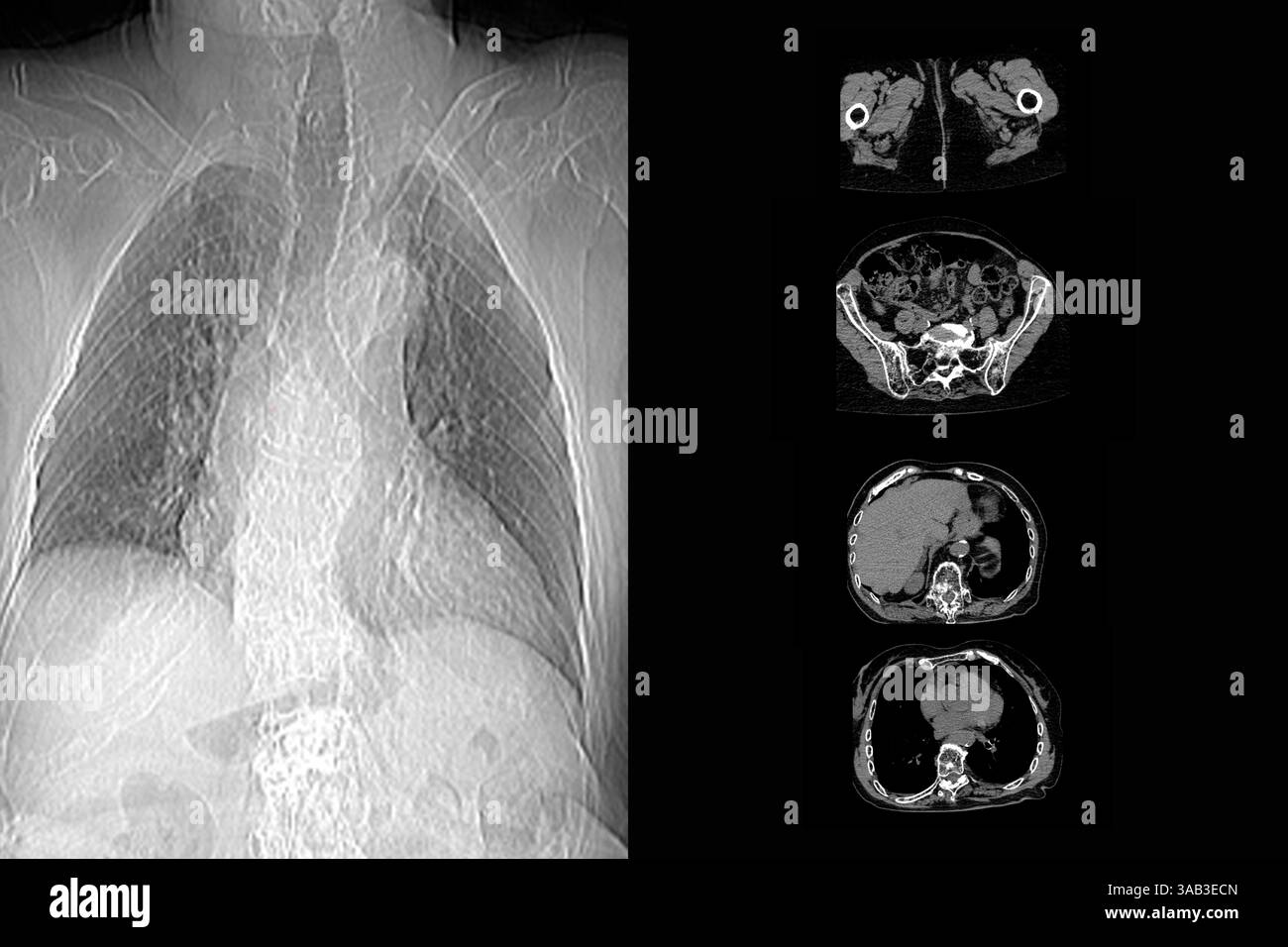 Compression Grand Compression fractures Banque de photographies et d’images à haute ...