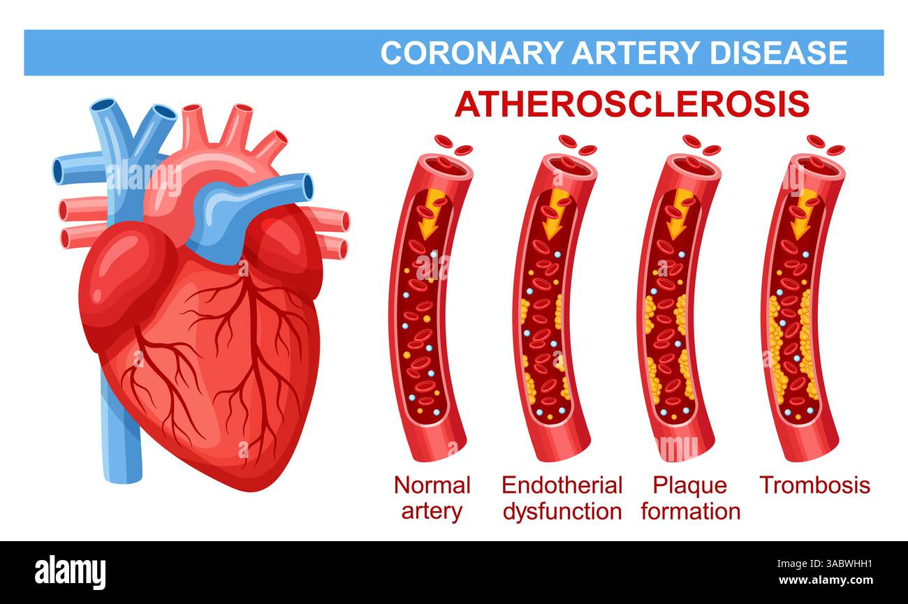 Maladie coronarienne, athérosclérose artérielle, crise cardiaque, cholestérol de blocage des vaisseaux sanguins. Thromboses du système cardiovasculaire. Cardiologie de la santé Illustration de Vecteur