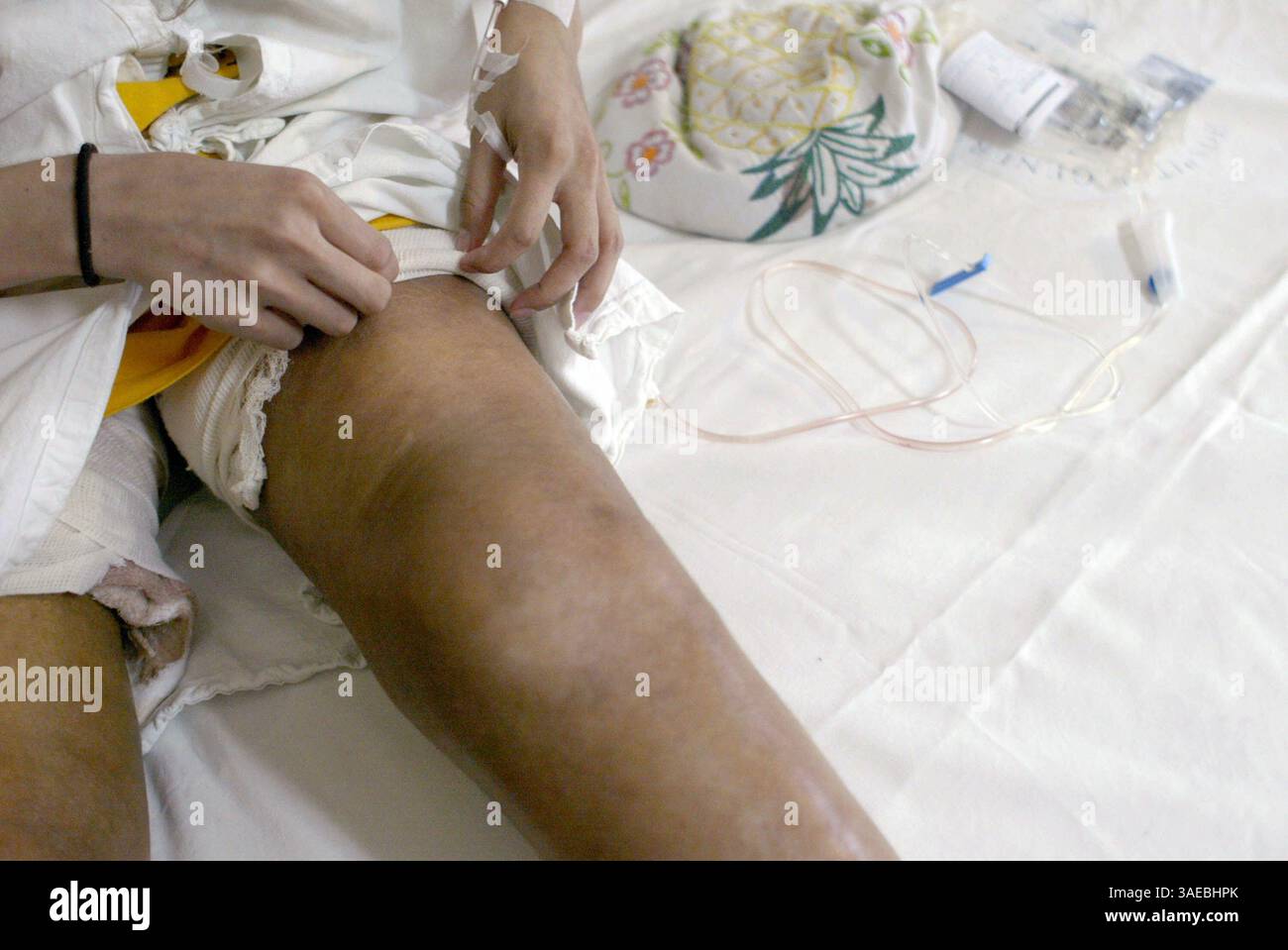 04 nov. 2004 ; Mexico, DF, Mexique ; les jambes de SILVIA sont si enflammées et sa peau si dure qu'elle est incapable de plier ses genoux enflés. Silvia n'est qu'à mi-chemin d'un séjour de 8 mois à l'hôpital général de Mexico, en raison d'ulcères, d'inflammations et d'infections 10 ans après avoir reçu des injections dans une clinique souterraine. . (Crédit image : Sarah Meghan Lee/ZUMAPRESS.com) Banque D'Images