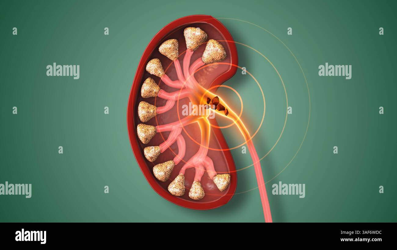 Calculs rénaux douloureux déclenchant une gêne urinaire Banque D'Images