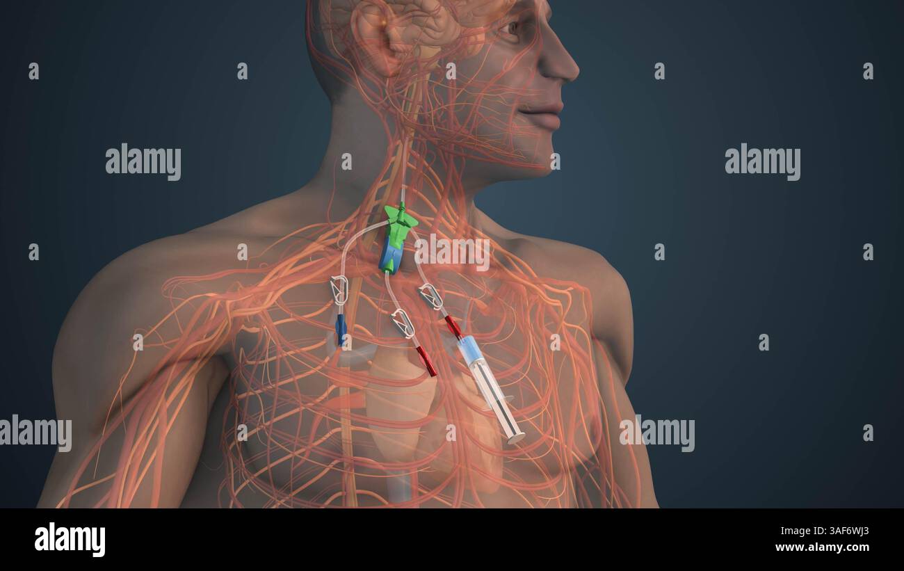 Activateur tissulaire recombinant du plasminogène dans le traitement des accidents vasculaires cérébraux Banque D'Images
