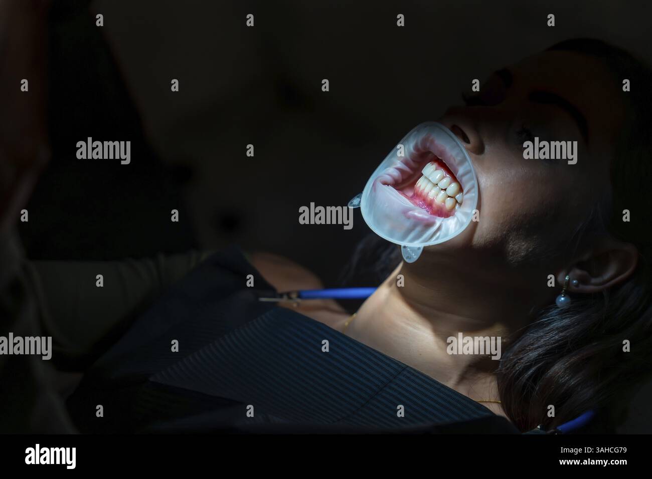 Patient recevant un traitement de blanchiment des dents avec un écarteur et lumière LED dans un cadre dentaire professionnel Banque D'Images Patient recevant un traitement de blanchiment des dents avec un écarteur et lumière LED dans un cadre dentaire professionnel Banque D'Images