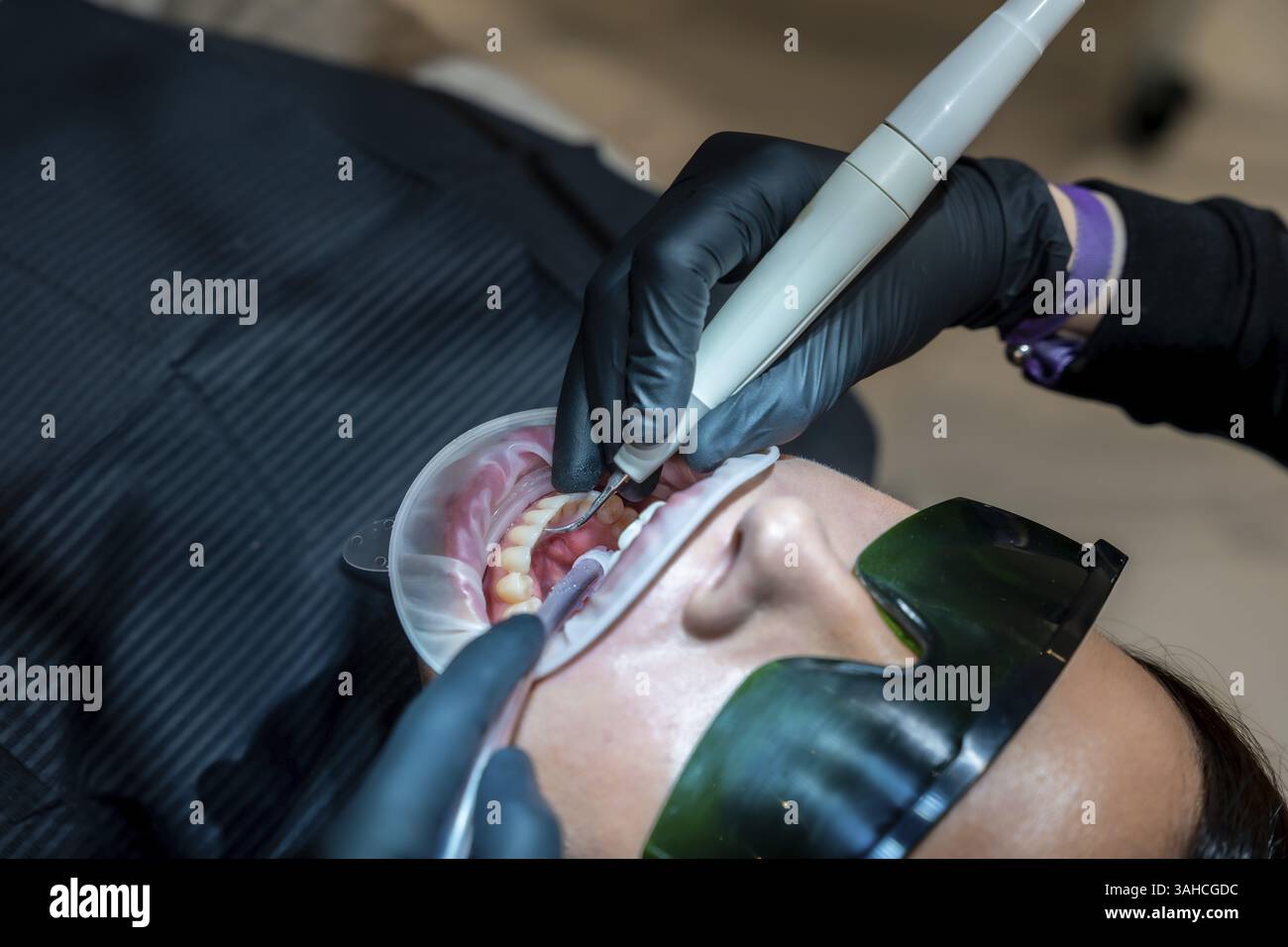Dentiste effectuant une procédure de blanchiment des dents à l'aide d'une lampe uv et d'un écarteur de joue sur un patient dans une clinique dentaire Banque D'Images Dentiste effectuant une procédure de blanchiment des dents à l'aide d'une lampe uv et d'un écarteur de joue sur un patient dans une clinique dentaire Banque D'Images