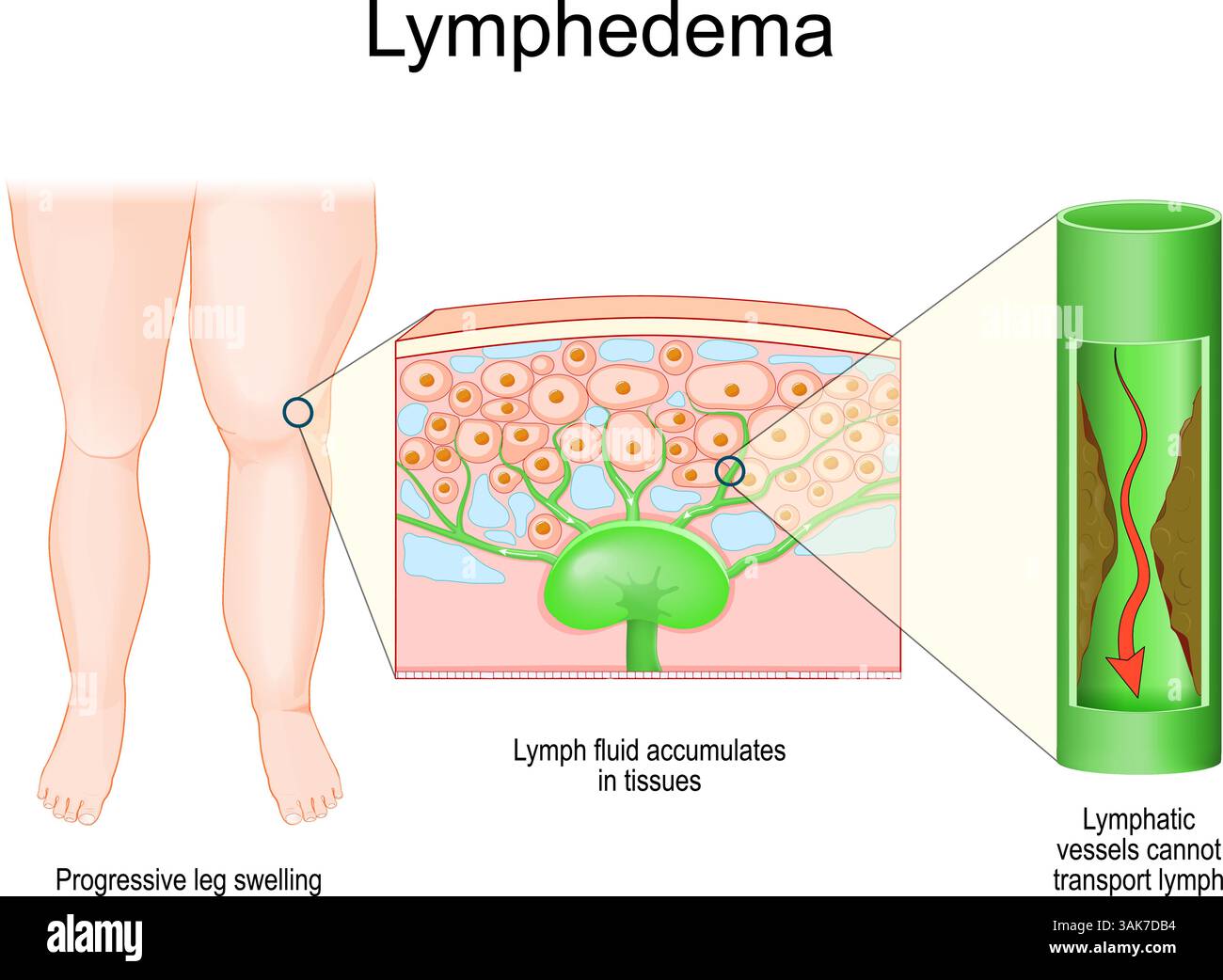 Lymphoedème. Gonflement progressif des jambes. Coupe transversale d'une peau avec ganglions lymphatiques et liquide qui s'accumule dans les tissus. Partie du système lymphatique humain. C Illustration de Vecteur
