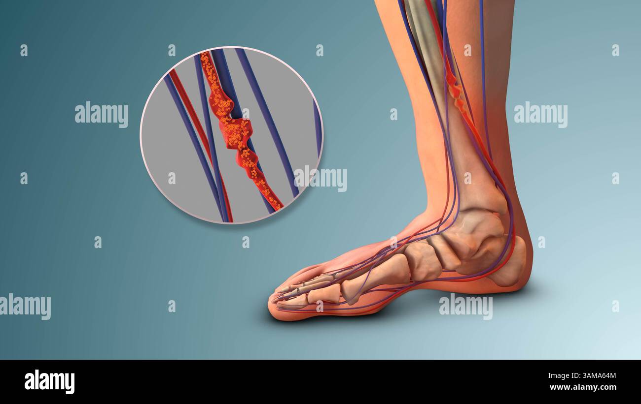Blocage veineux de jambe par thrombose profonde Banque D'Images