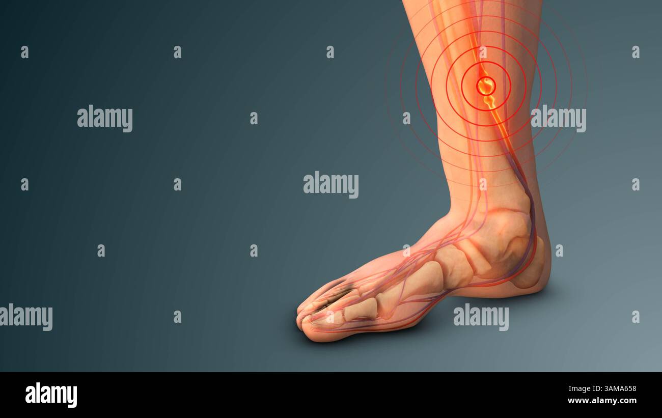 Thrombose veineuse profonde affectant la circulation des jambes Banque D'Images