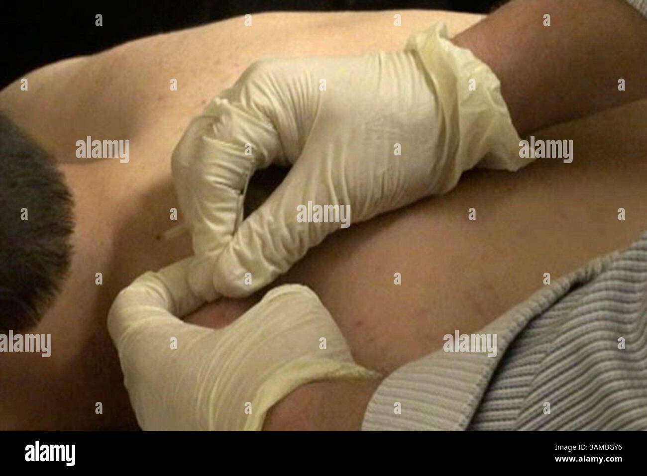 23 janvier 2014 - Phoenix, AZ, États-Unis - Un patient reçoit un traitement d'aiguilletage sec du physiothérapeute Sean Flannagan, janvier 2014, en Arizona. (Crédit image : © Rachel Leingang/MCT/ZUMAPRESS.com) Banque D'Images