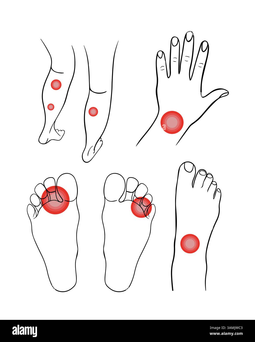 Illustration isolée vectorielle d'un ensemble de douleur dans le bras et la jambe. Traumatismes des membres humains. Illustration de Vecteur Illustration isolée vectorielle d'un ensemble de douleur dans le bras et la jambe. Traumatismes des membres humains. Illustration de Vecteur