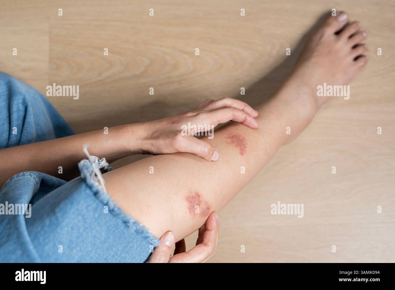 Gros plan d'une femme ayant des démangeaisons causées par une éruption rouge sur sa cuisse. Soulagement de la douleur du pied jeune femme traitant les démangeaisons de l'inconfort cutané relaxation thérapie à domicile. Banque D'Images
