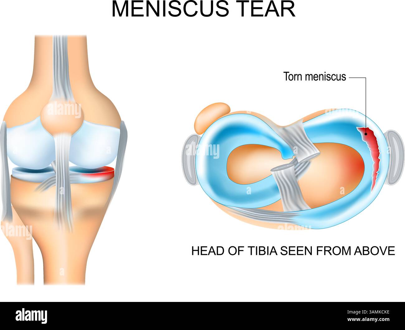 Déchirure du ménisque. Anatomie du genou. Gros plan d'un ménisque déchiré et d'une lésion du cartilage. Plaie sportive du genou. Tête du tibia vue d'en haut. Illustration vectorielle. M Illustration de Vecteur