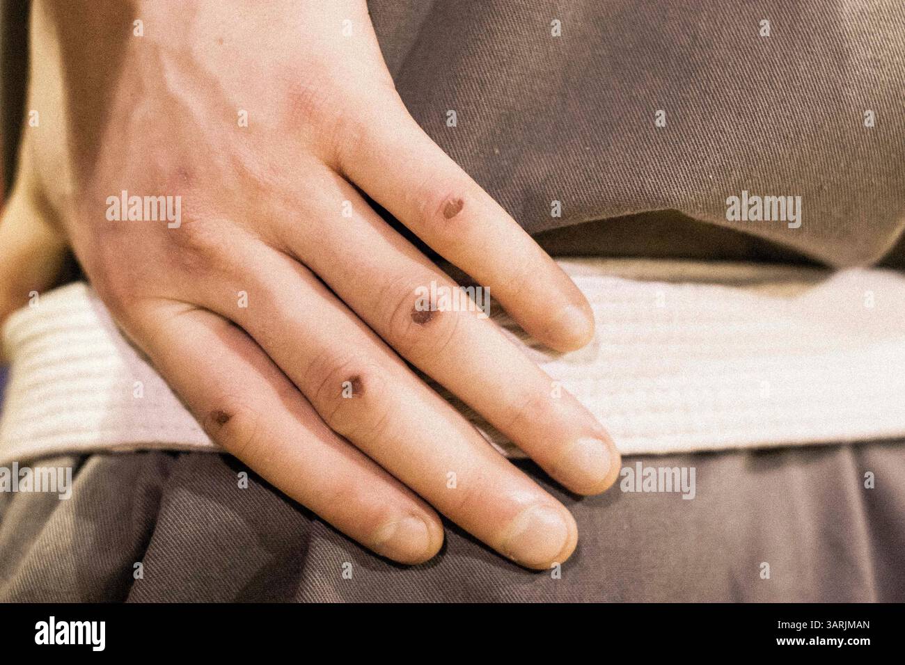 21 janvier 2013 - Cardiff, Galles du Sud, Royaume-Uni - la main de l'étudiant ADAM PLENERT. Il s'est blessé les mains parce qu'il s'entraînait trop fort, mais il n'a pris aucune mesure de protection pour protéger ses mains. (Crédit image : © Jiwei Han/ZUMAPRESS.com) Banque D'Images