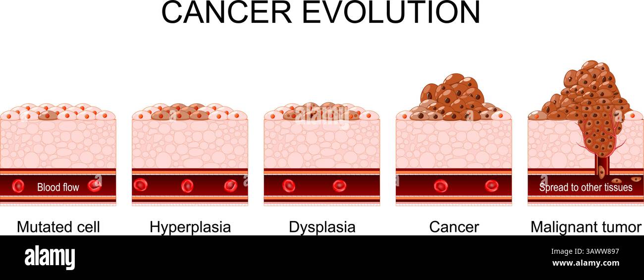 Evolution du cancer de l'hyperplasie et de la cellule mutée à la dysplasie, au cancer et à la tumeur maligne. Coupe transversale d'un tissu humain. Illustration vectorielle. Moyen Illustration de Vecteur