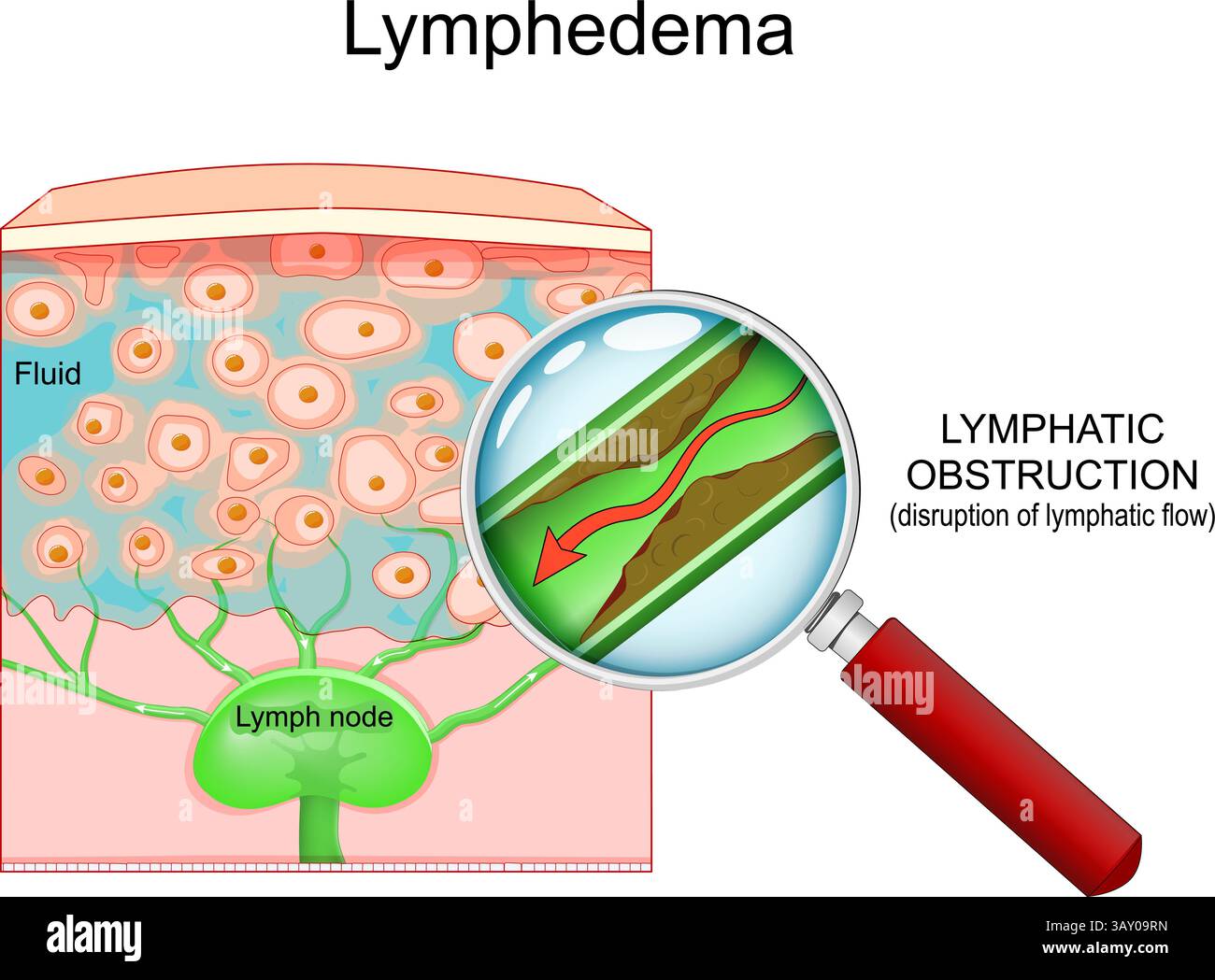 Lymphoedème. Coupe transversale d'une peau humaine et d'un ganglion lymphatique. Un vaisseau lymphatique avec un flux lymphatique perturbé est visible à travers la loupe Illustration de Vecteur
