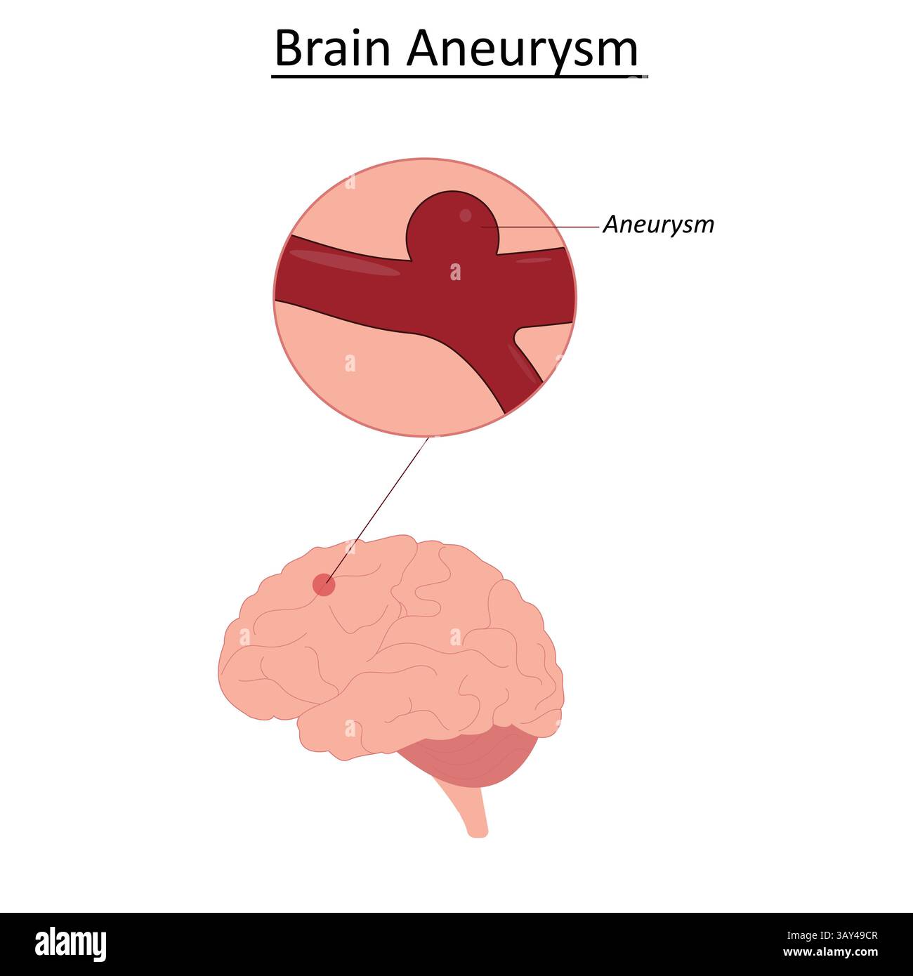 Anévrisme sur l'illustration vectorielle du cerveau Illustration de Vecteur