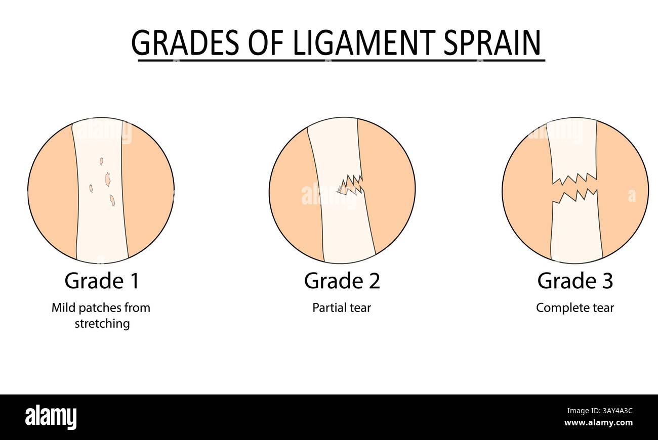Grades d'illustration vectorielle d'entorse ligamentaire Illustration de Vecteur