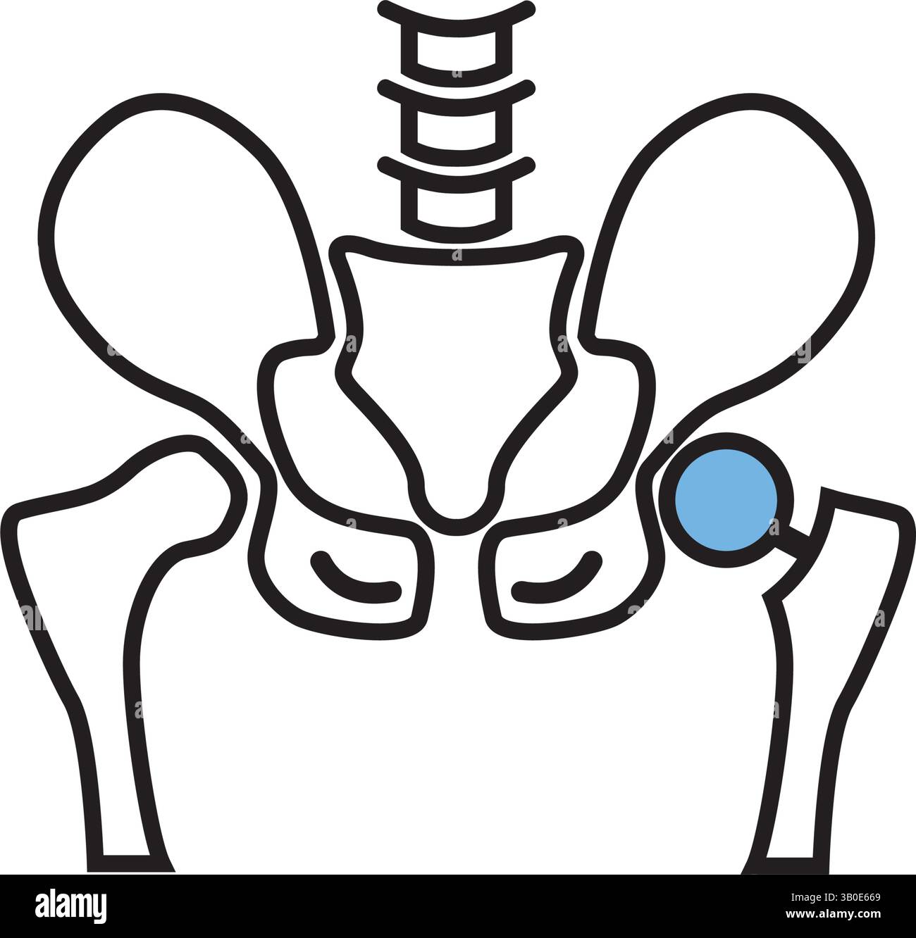 Icône noire de ligne d'arthroplastie. Implant de prothèse de hanche installé dans l'os pelvien. Elément vectoriel isolé. Illustration de Vecteur