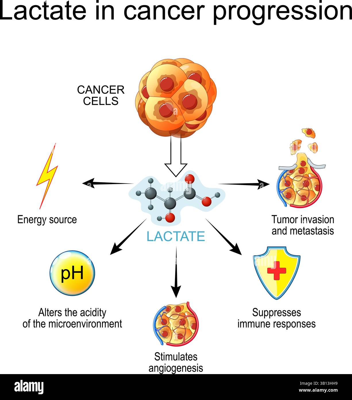 Développement tumoral. Le lactate dans la progression du cancer. Oncogenèse. Croissance néoplasique. Illustration vectorielle. Affiche médicale. Schéma de principe Illustration de Vecteur
