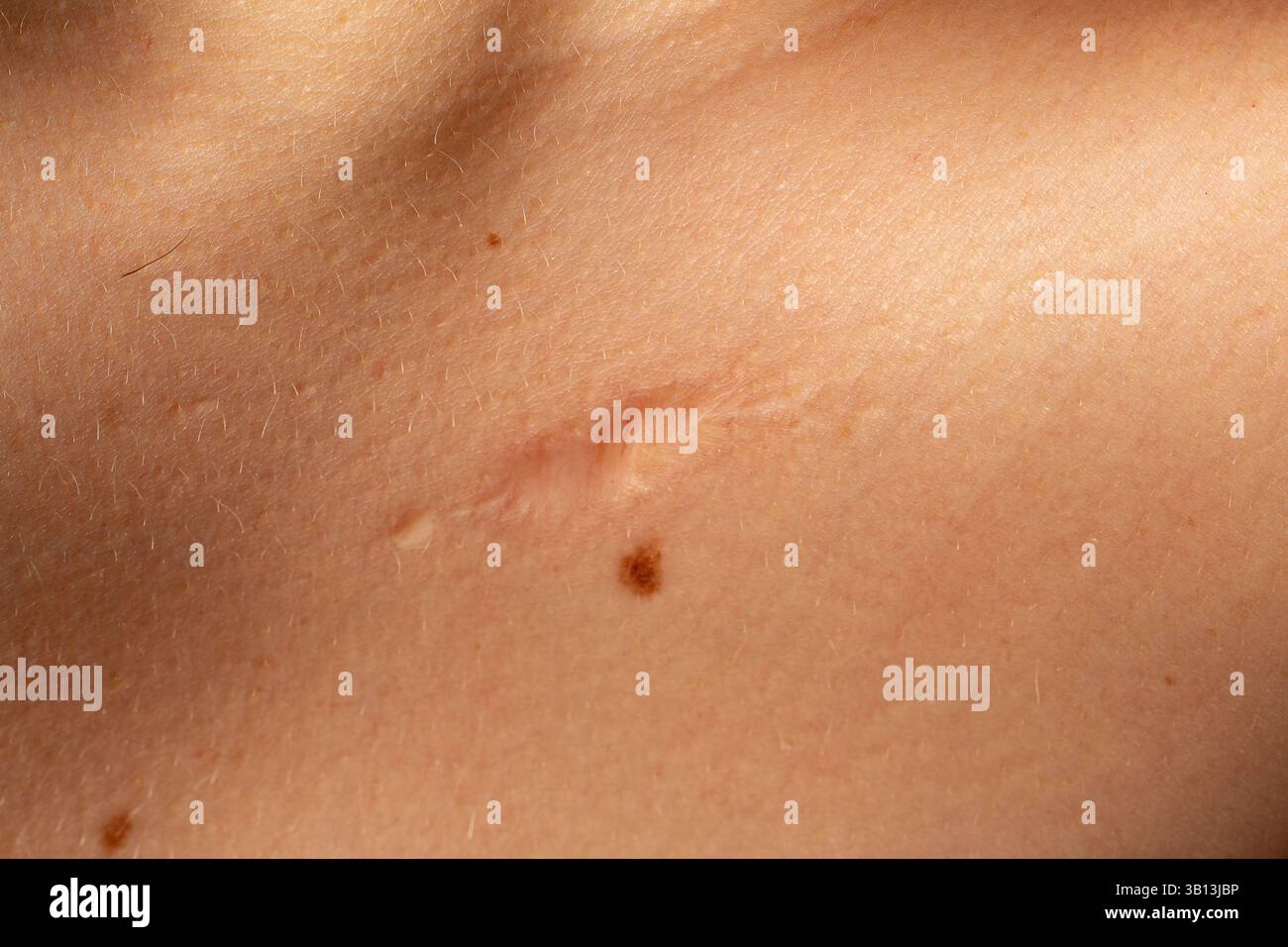 Gros plan d'une cicatrice cicatrisante sur la peau humaine, mettant en évidence le processus naturel de guérison du corps Banque D'Images