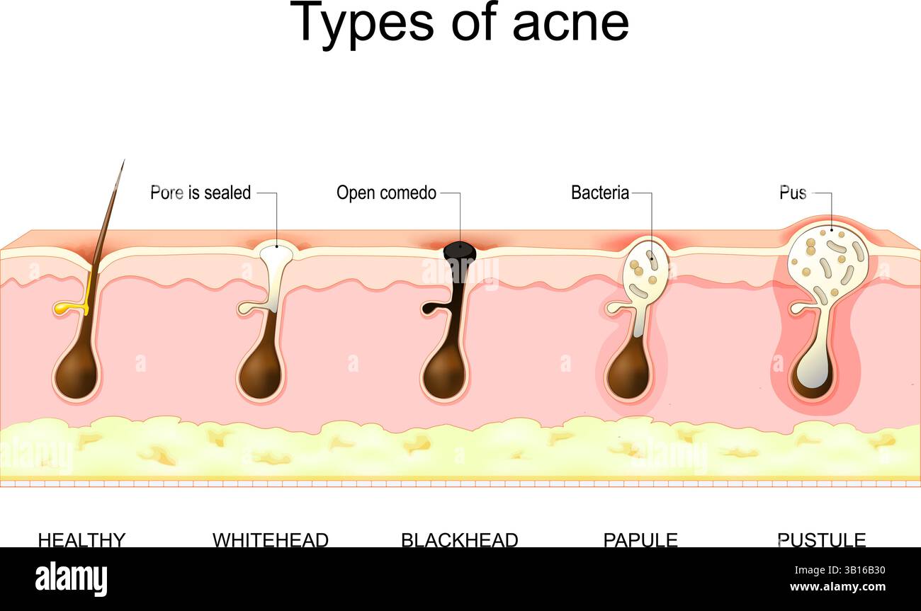 Types de boutons d'acné. Peau saine, Whiteheads et Blackheads, papules et pustules. Illustration vectorielle. Affiche médicale. Schéma de principe Illustration de Vecteur