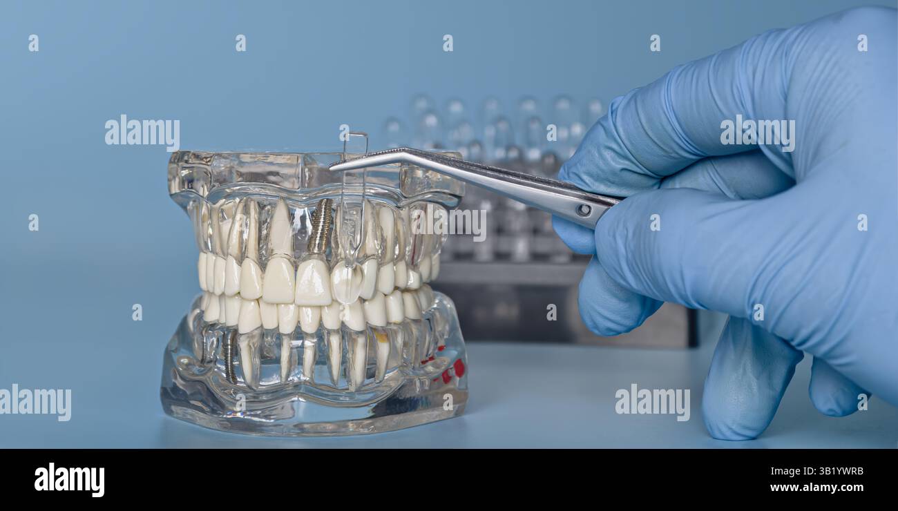 Démonstration d'un implant dentaire avec Banque D'Images