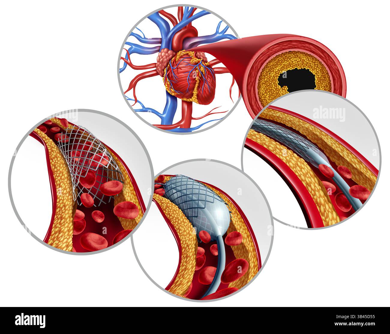 Stent dans l'artère coronaire comme un concept de schéma médical d'angioplastie cardiaque avec un cathéter à ballonnet comme une procédure chirurgicale de cardiologie avec comme un coeur Banque D'Images