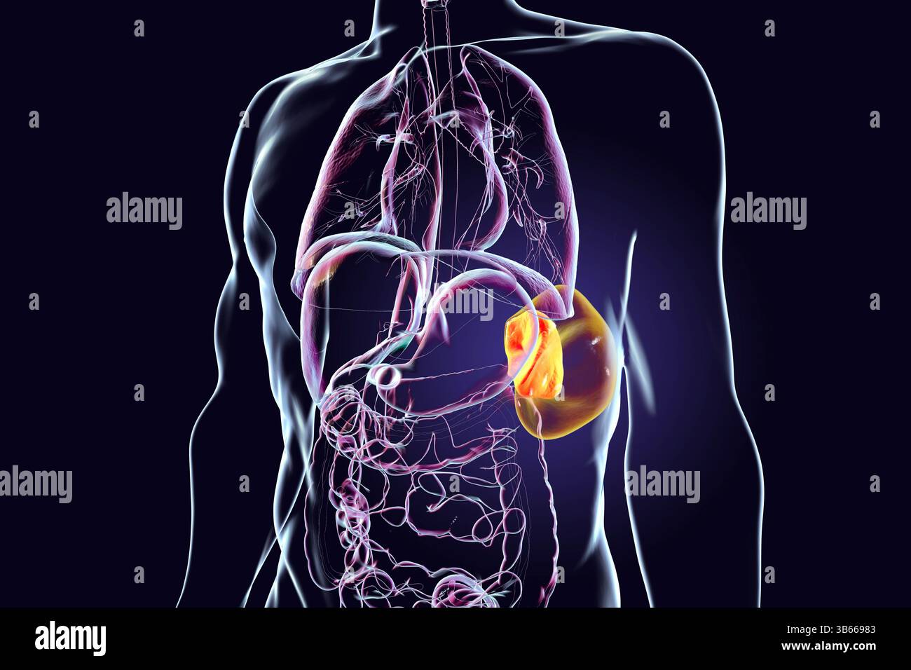 Illustration d'une splénomégalie (orange transparent), montrant une rate élargie par rapport à une rate normale (orange Uni). Cela se produit dans les infections, cirrhose du foie, leucémie, lymphome, paludisme, et les maladies auto-immunes. Banque D'Images