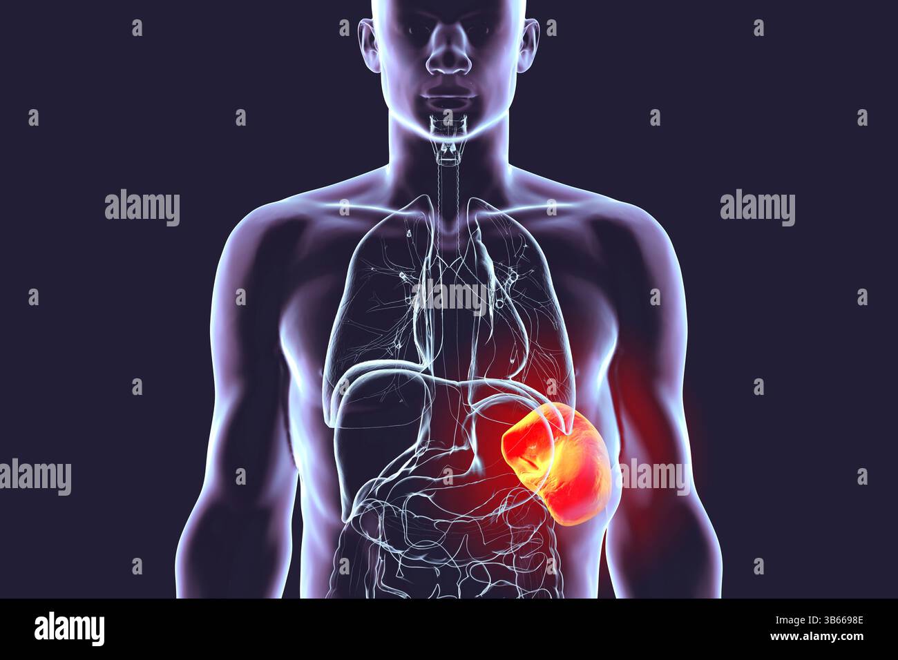 Illustration d'une splénomégalie, montrant une rate élargie. Cela se produit dans les infections, cirrhose du foie, leucémie, lymphome, paludisme, et les maladies auto-immunes. Banque D'Images