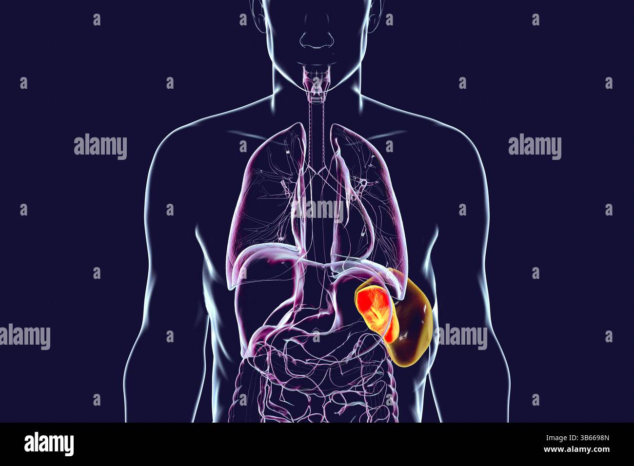Illustration d'une splénomégalie (orange transparent), montrant une rate élargie par rapport à une rate normale (orange Uni). Cela se produit dans les infections, cirrhose du foie, leucémie, lymphome, paludisme, et les maladies auto-immunes. Banque D'Images