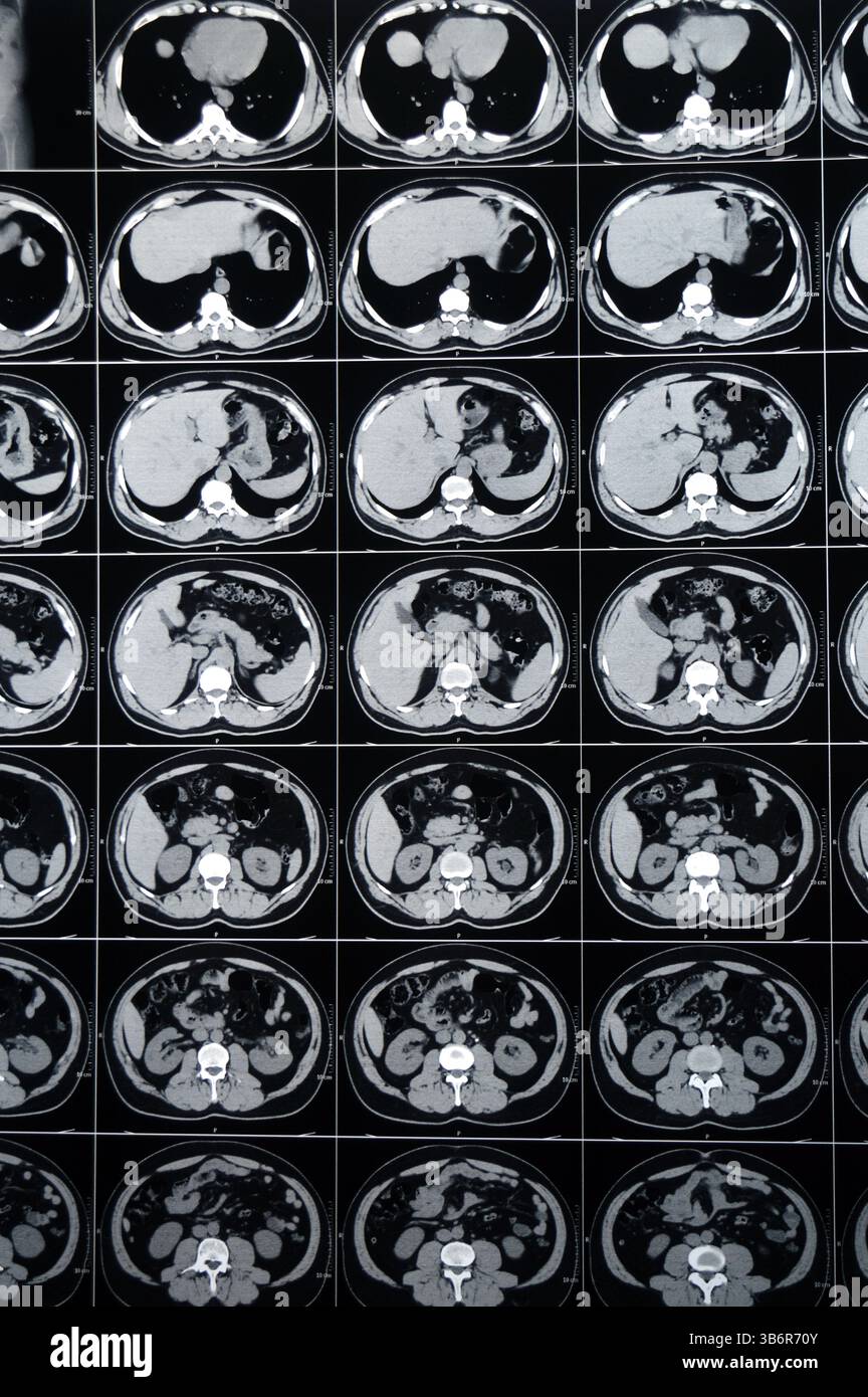 La tomodensitométrie de l'abdomen et du bassin montre un calcul urétéral supérieur gauche avec un léger effet de contre-pression, un petit calcul calcaire rénal droit non obstruant, calcif Banque D'Images