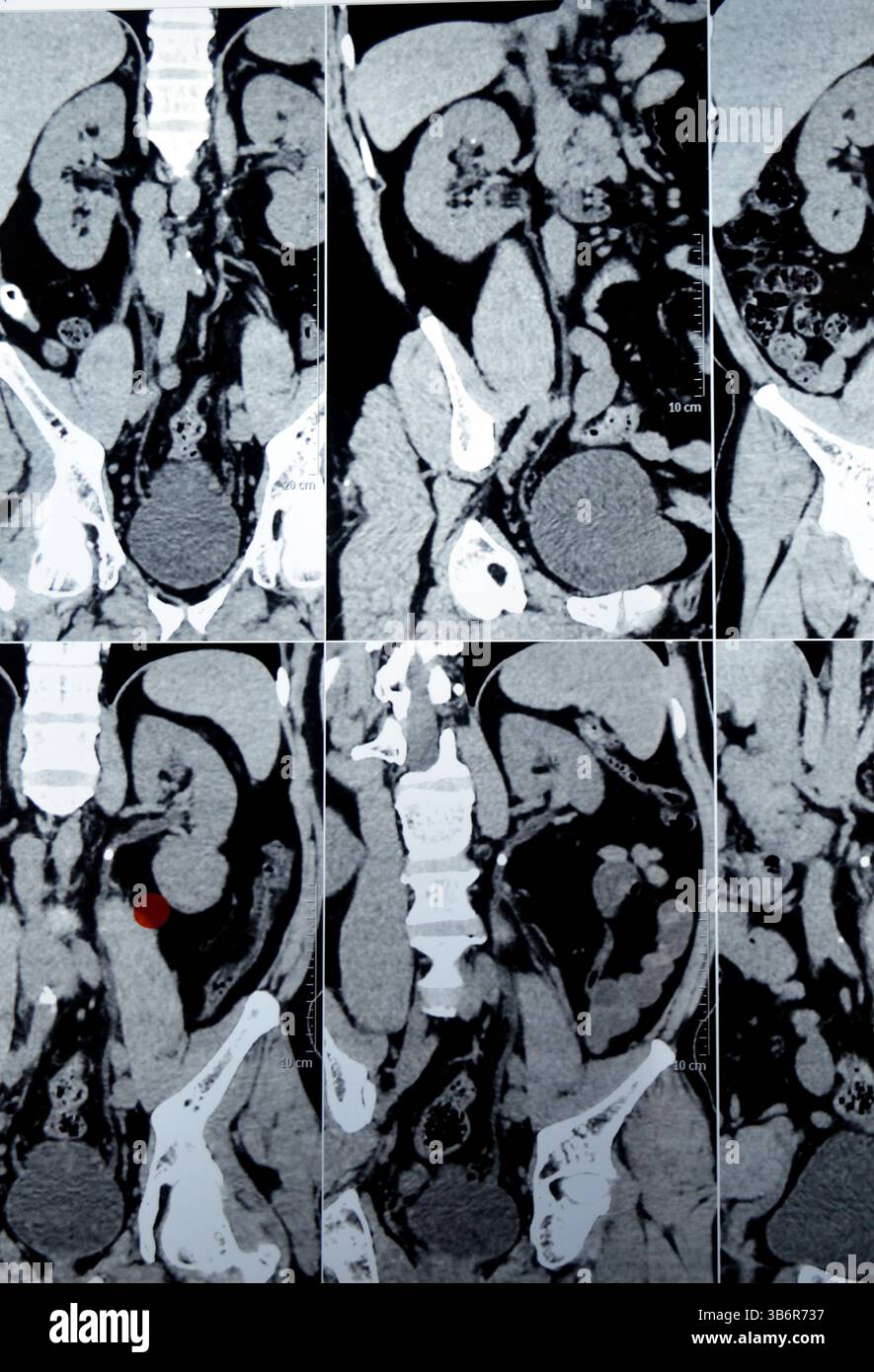 La tomodensitométrie de l'abdomen et du bassin montre un calcul urétéral supérieur gauche avec un léger effet de contre-pression, un petit calcul calcaire rénal droit non obstruant, calcif Banque D'Images