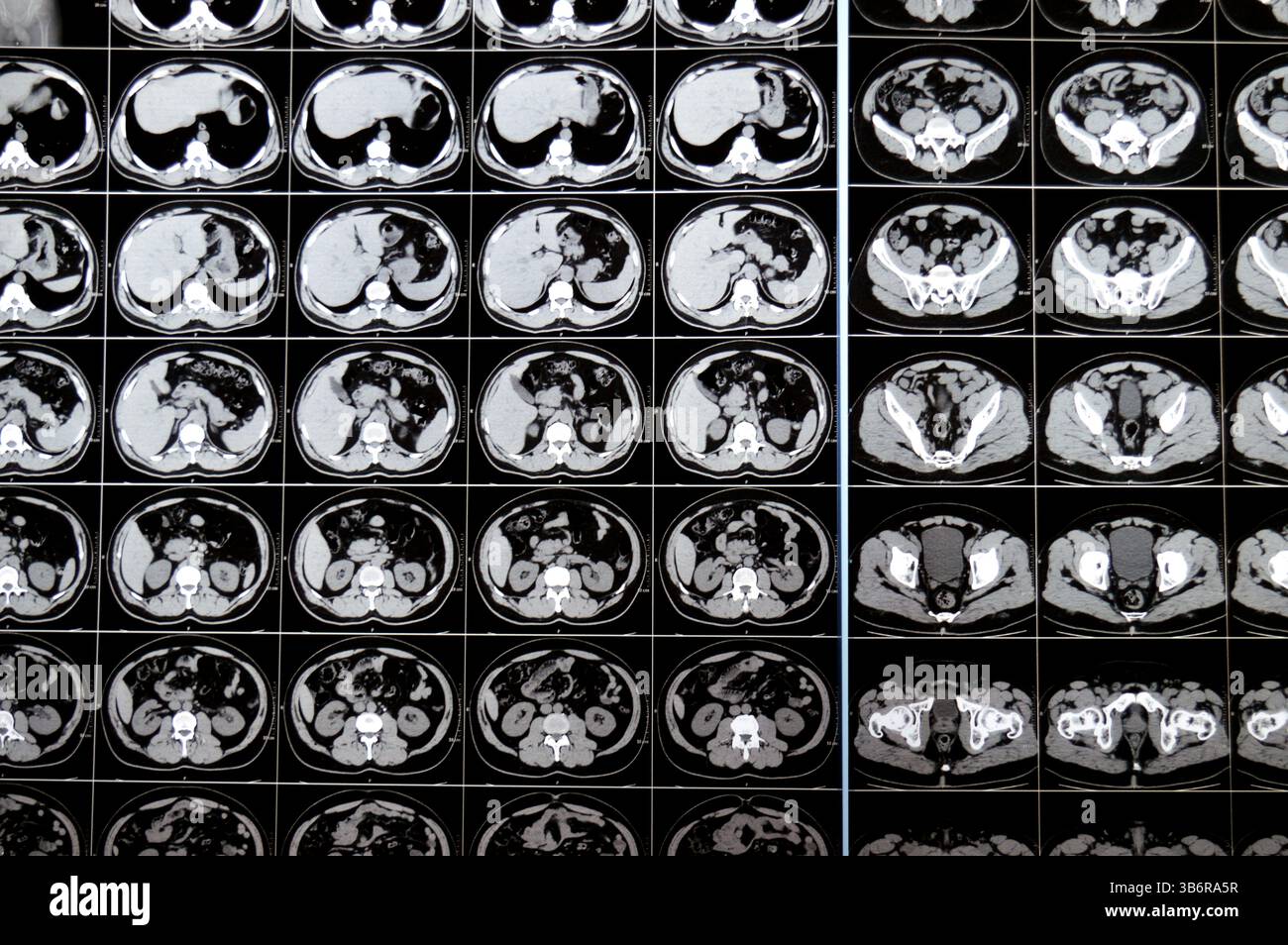 La tomodensitométrie de l'abdomen et du bassin montre un calcul urétéral supérieur gauche avec un léger effet de contre-pression, un petit calcul calcaire rénal droit non obstruant, calcif Banque D'Images