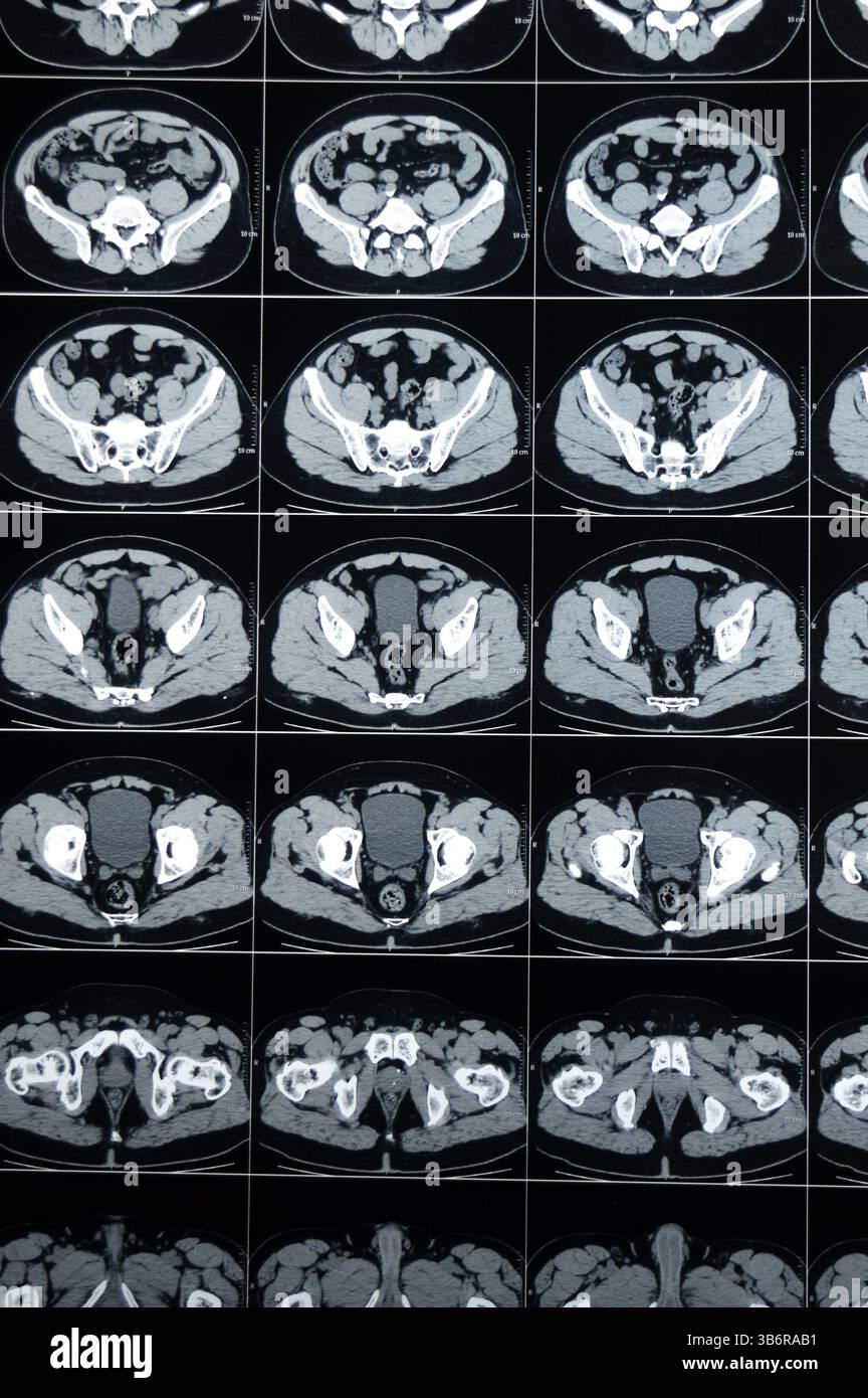 La tomodensitométrie de l'abdomen et du bassin montre un calcul urétéral supérieur gauche avec un léger effet de contre-pression, un petit calcul calcaire rénal droit non obstruant, calcif Banque D'Images
