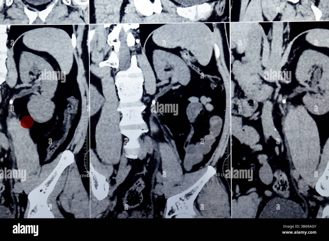 La tomodensitométrie de l'abdomen et du bassin montre un calcul urétéral supérieur gauche avec un léger effet de contre-pression, un petit calcul calcaire rénal droit non obstruant, calcif Banque D'Images